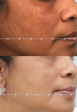 43years Female Anti Aging Results 4 Months Timeline 5 Sessions ClearSkin Pune