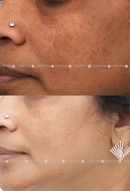 43years Female Anti Aging Results 4 Months Timeline 5 Sessions ClearSkin Pune