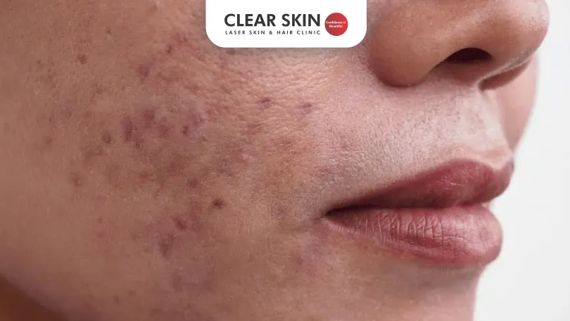 what causes hyperpigmentation after acne