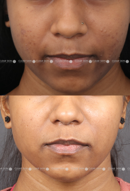 19 yrs Pigmentation Results 4 Months Timeline 6 Sessions Clear Skin Pune