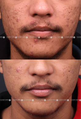 21 yrs male Acne Results 6 Months Timeline 6 Sessions ClearSkin Pune