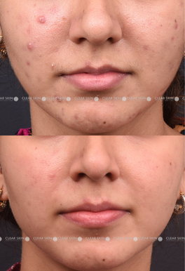 24 yrs Female Acne Results 4 Months Timeline 5 Sessions Clear Skin Pune