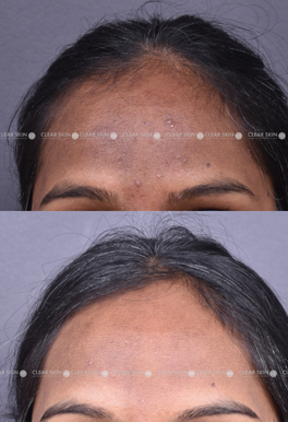 25yrs Pigmentation Results 6 Months Timeline 6 Sessions Clear Skin Pune