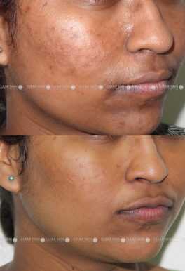 26 yrs Pigmentation Results 4 Months Timeline 4 Sessions Clear Skin Pune