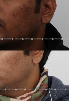 29 Pigmentation Results 3 Months Timeline 4 Sessions Clear Skin Pune