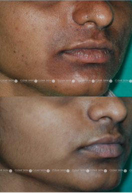 32yrs Female Pigmentation Results 6 Months Timeline 7 Sessions Clear Skin Pune