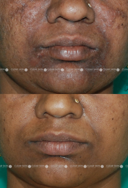 34 yrs Female Pigmentation Results 6 Months Timeline 7 Sessions Clear Skin Pune