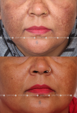 34 yrs Female Melasma Results 9 Months Timeline 10 Sessions Clear Skin Pune