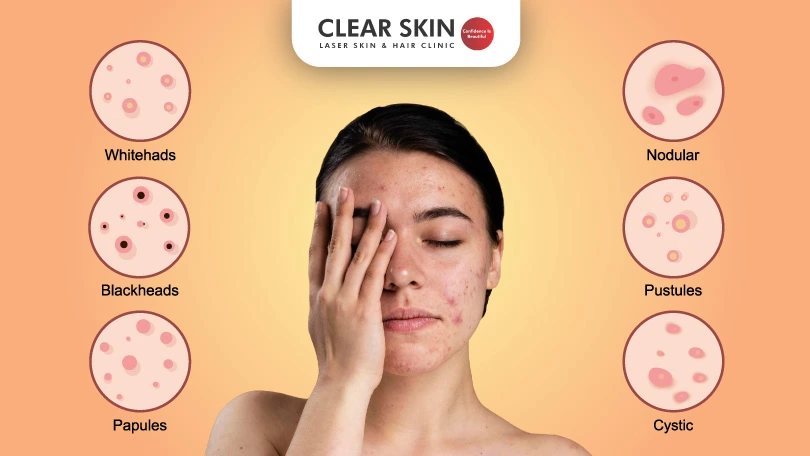 Various Types of Acne: Causes, Symptoms, and Treatments