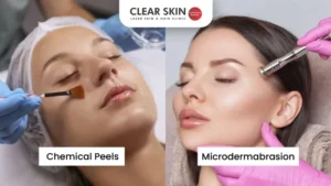 chemical peels & microdermabrasion