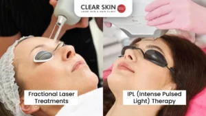 fractional laser treatment & IPL( intense pulsed light )