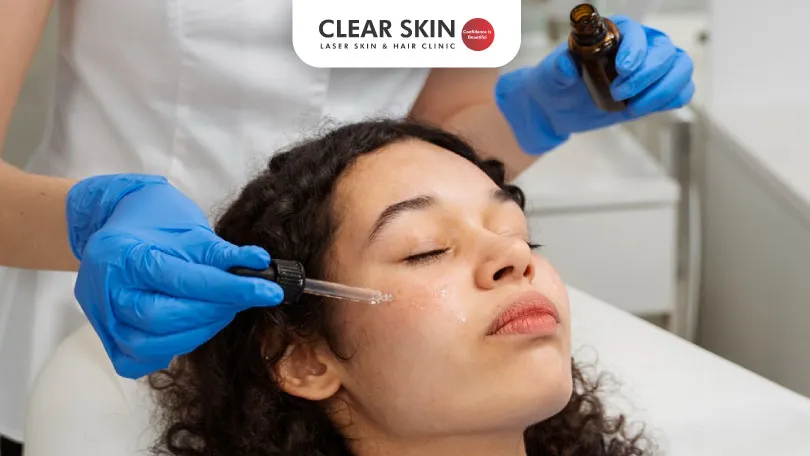 Chemical peels for pigmentation