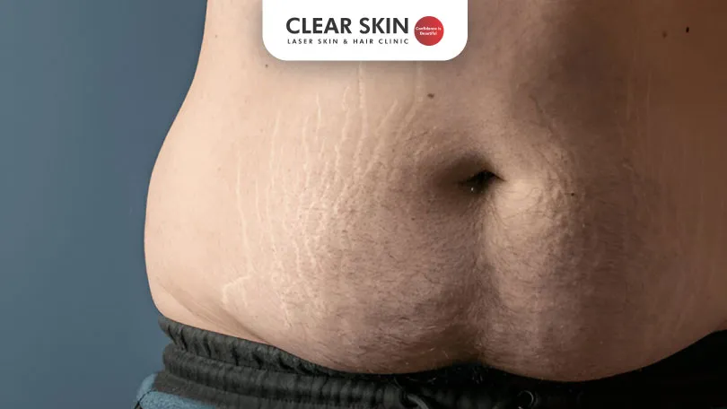 Stretch Marks in Men: Causes, Prevention, and Treatment