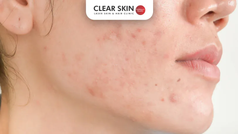 Can Acne Scars Be Completely Removed?